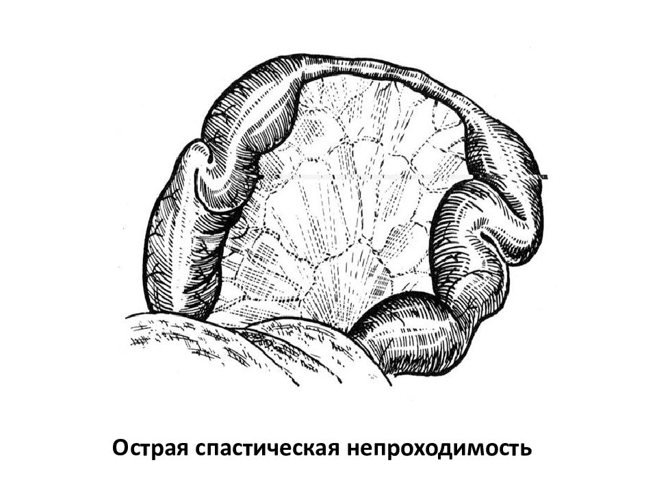 Презентация динамическая кишечная непроходимость