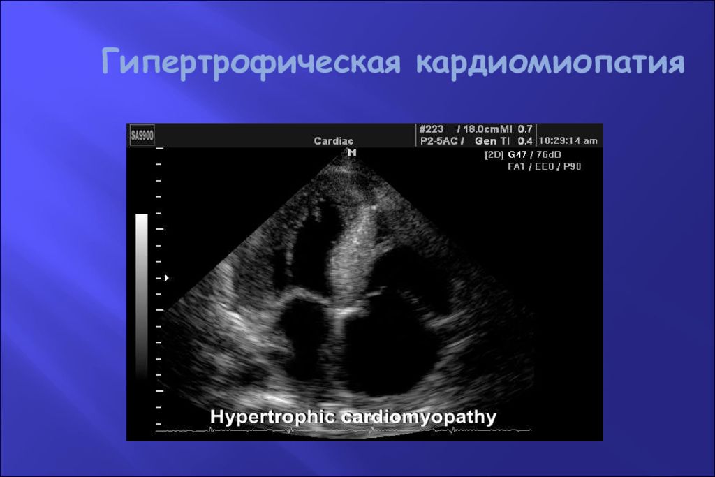 Гипертрофическая кмп обычно характеризуется толщиной стенки лж по данным эхокг
