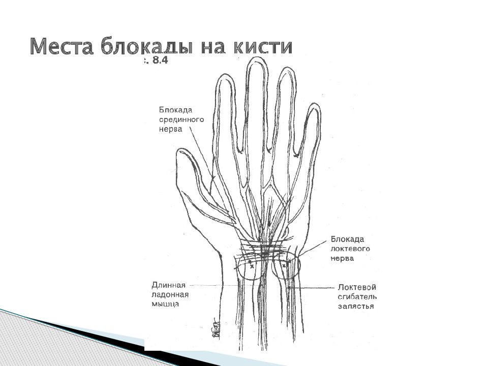 Блокада нерва. Блокада нервов на уровне запястья. Блокада нервов кисти на уровне запястья. Блокада поверхностной ветви лучевого нерва. Проводниковая анестезия запястья.