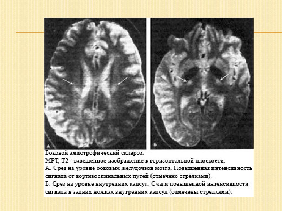 Бас клиническая картина