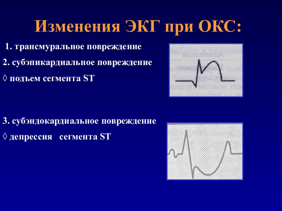 Экг синдромы при окс