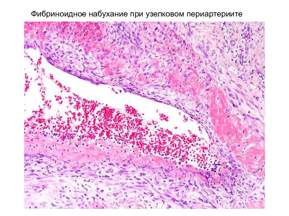 Фибриноидное набухание это. Фибриноидное набухание клапана сердца гистология. Фибриноидное набухание клапана сердца патологическая анатомия. Фибриноидное набухание патанатомия. Мезенхимальные дистрофии фибриноидное набухание.