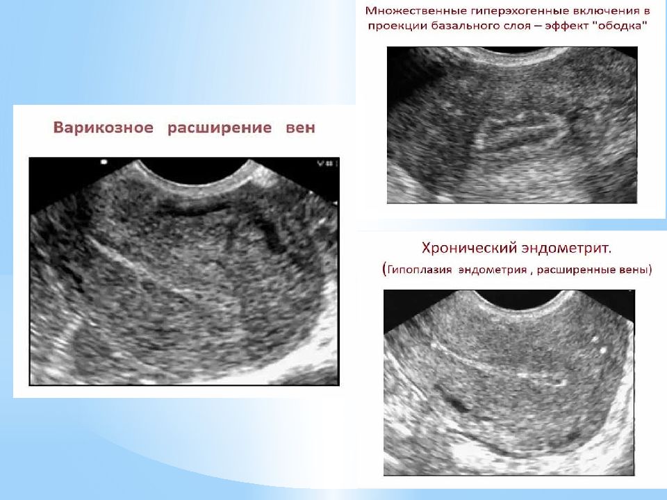 Эндометрит узи картина