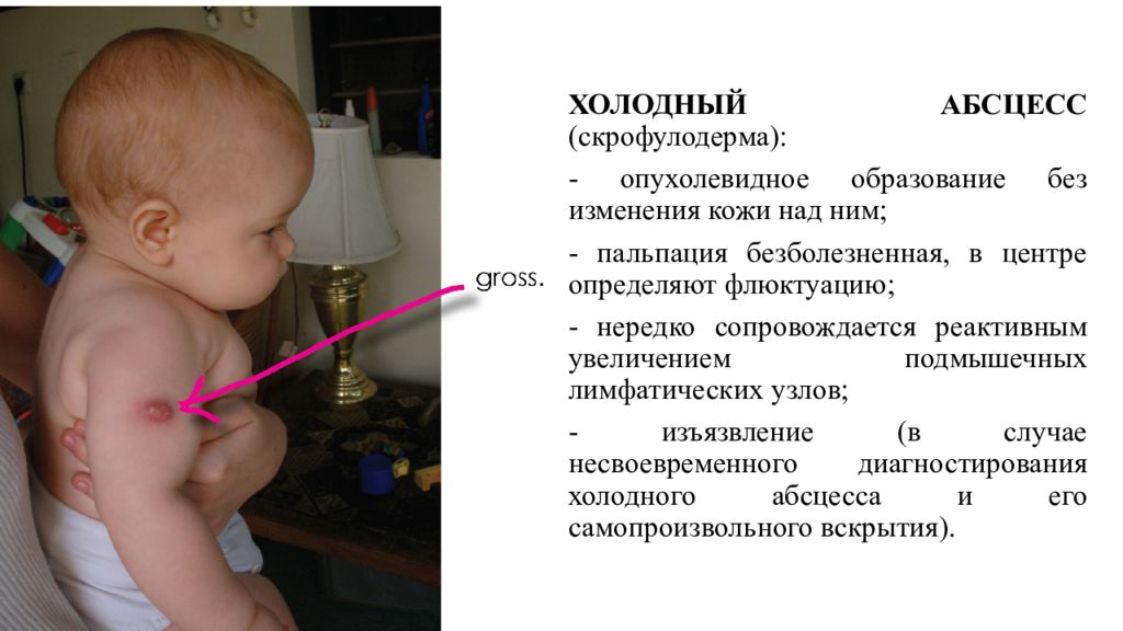 Бцж расшифровка у новорожденных. Реакция БЦЖ по месяцам. Холодный абсцесс после БЦЖ. Прививка БЦЖ после холодного абсцесса.