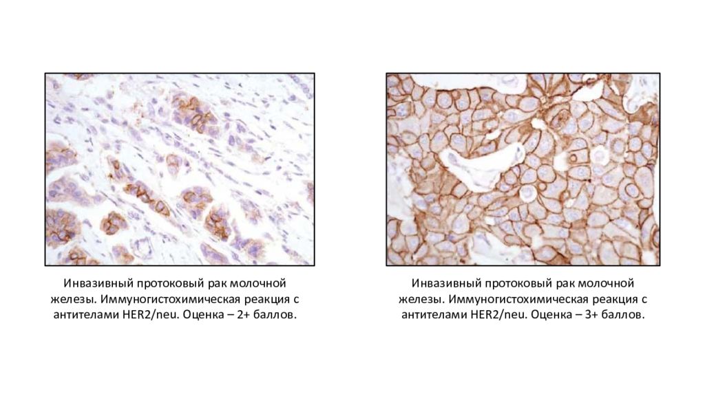 Инвазивная карцинома. Непрямой иммуногистохимический метод. Иммуногистохимическое исследование молочной железы. Схема иммуногистохимического исследования. Иммуногистохимическое исследование опухоли молочной железы.