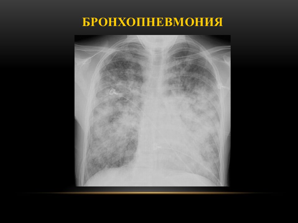 Очаговый бронхит. Правосторонняя бронхопневмония рентген. Лобарная бронхопневмония. Двухсторонняя очаговая бронхопневмония. Двухсторонняя очаговая пневмония рентген.