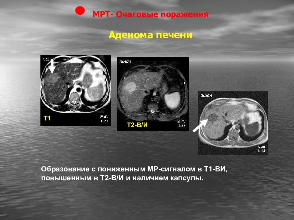 Очаговые поражения печени презентация