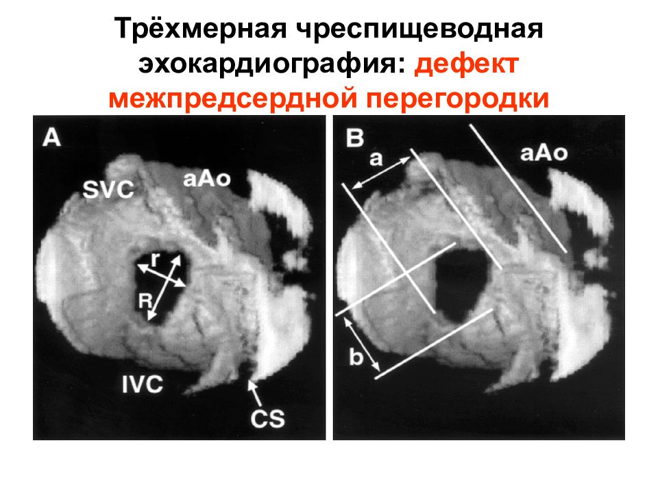 Операция межпредсердной перегородки. Сетчатый дефект межпредсердной перегородки. Дефект межпредсердной перегородки рентген. Дефект межпредсердной перегородки эхокардиография.