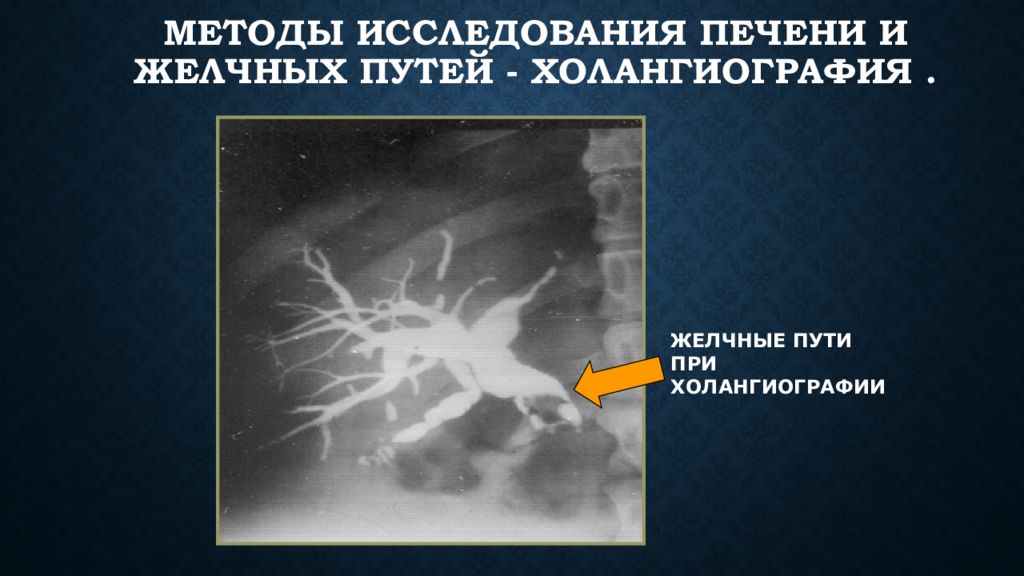 Исследование печени. Лучевое исследование печени и желчевыводящих путей. Методы исследования печени и желчных путей. Холангиография желчевыводящих путей. Рентгенологические методы исследования печени.