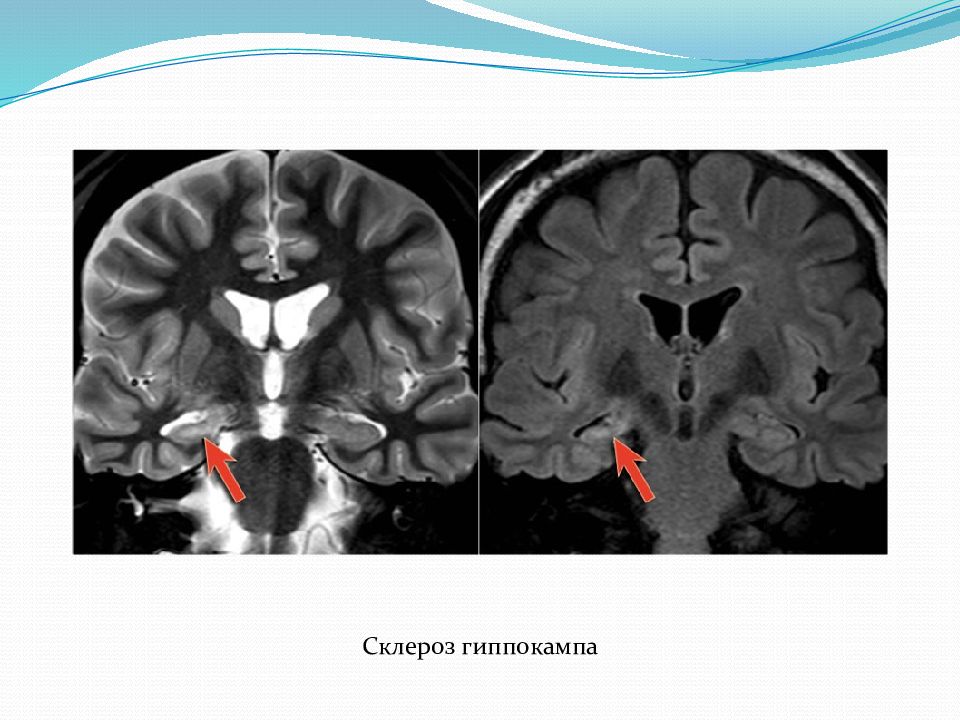 Мезиальный темпоральный склероз. Гиппокамп на мрт. Темпоральный склероз гиппокампа. Гиппокамп анатомия мрт.