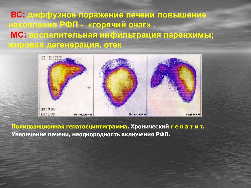 Вторичное поражение. Горячий очаг сцинтиграфия печень. Сцинтиграфия печени РФП. Горячие и холодные очаги сцинтиграфия. Диффузное повышение накопления РФП.