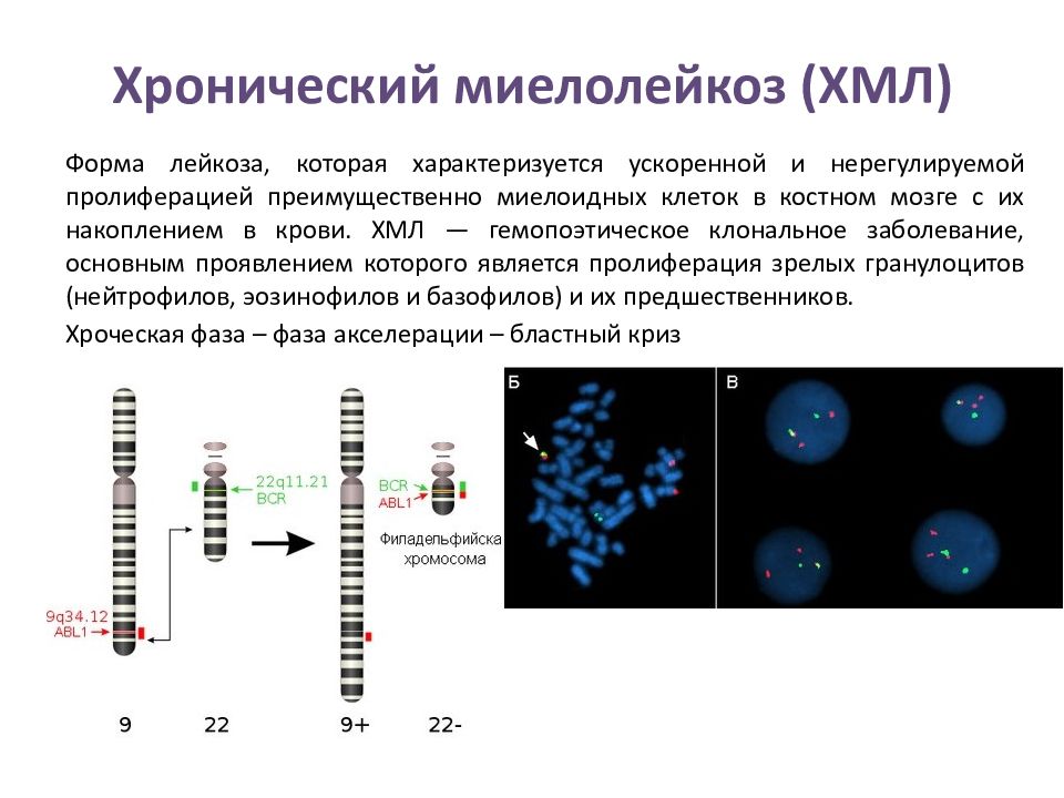 Хр миелолейкоз картина крови