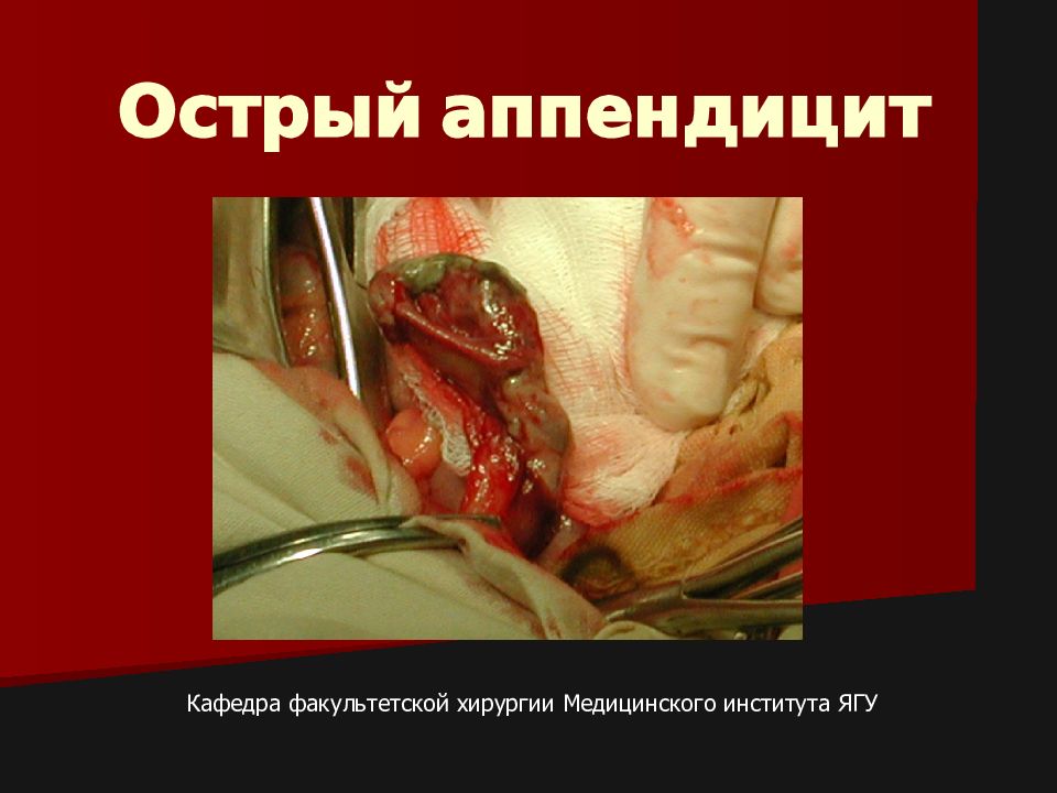 Острый аппендицит