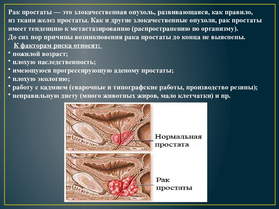 Рак предстательной железы презентация по урологии