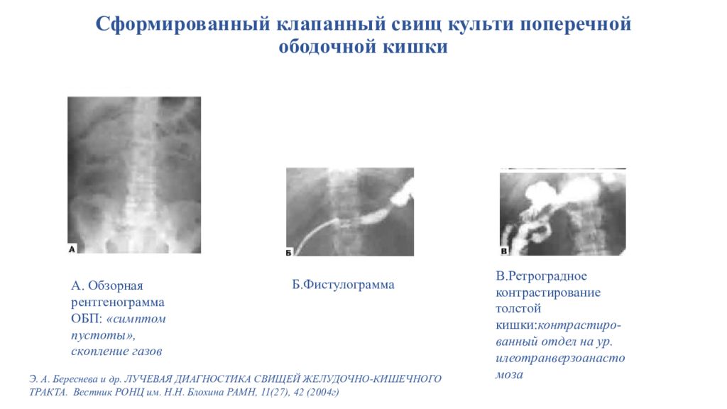 Ректовагинальный свищ нмо