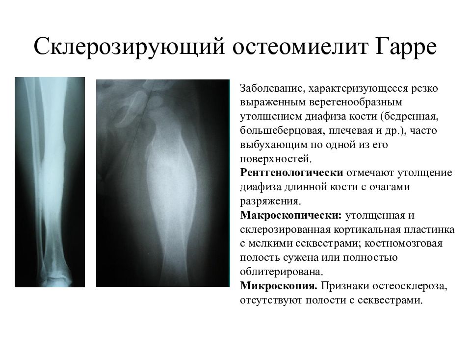 Для рентгенологической картины фолликулярной кисты характерна деструкция костной ткани