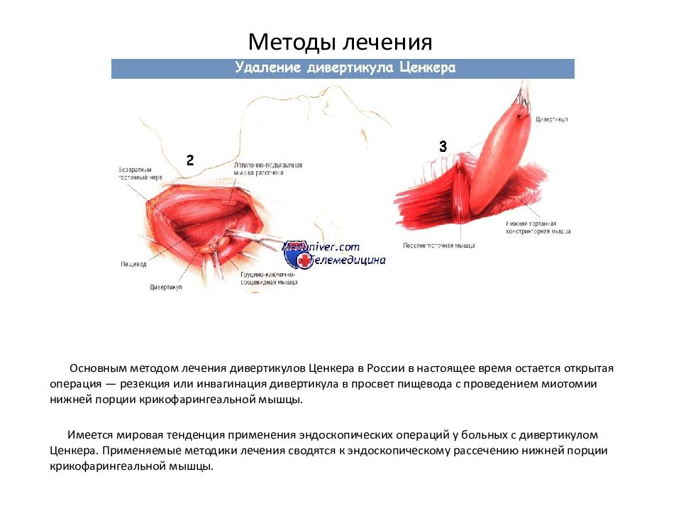 Дивертикулы пищевода презентация