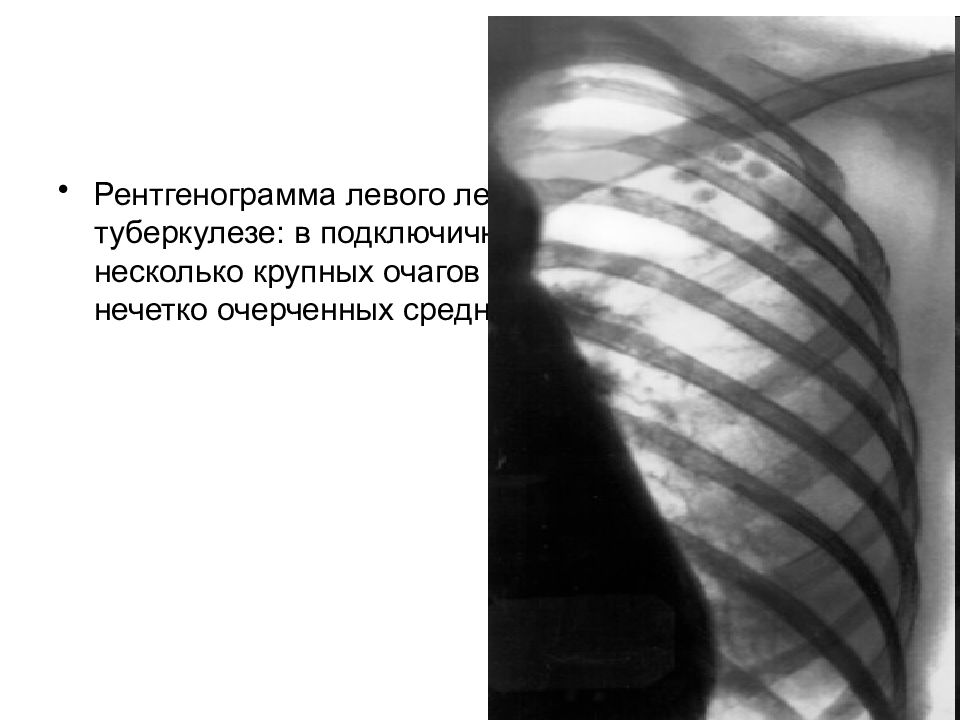 Очаговый туберкулез легких рентген. Очаговый туберкулёз лёгких рентген. Рентгенологическая картина очагового туберкулеза. Очаговый туберкулез легких на рентгенограмме. Тень в левом легком
