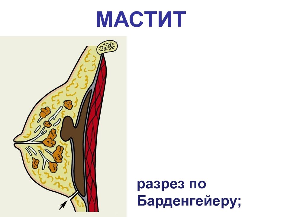 Мастит хирургия презентация