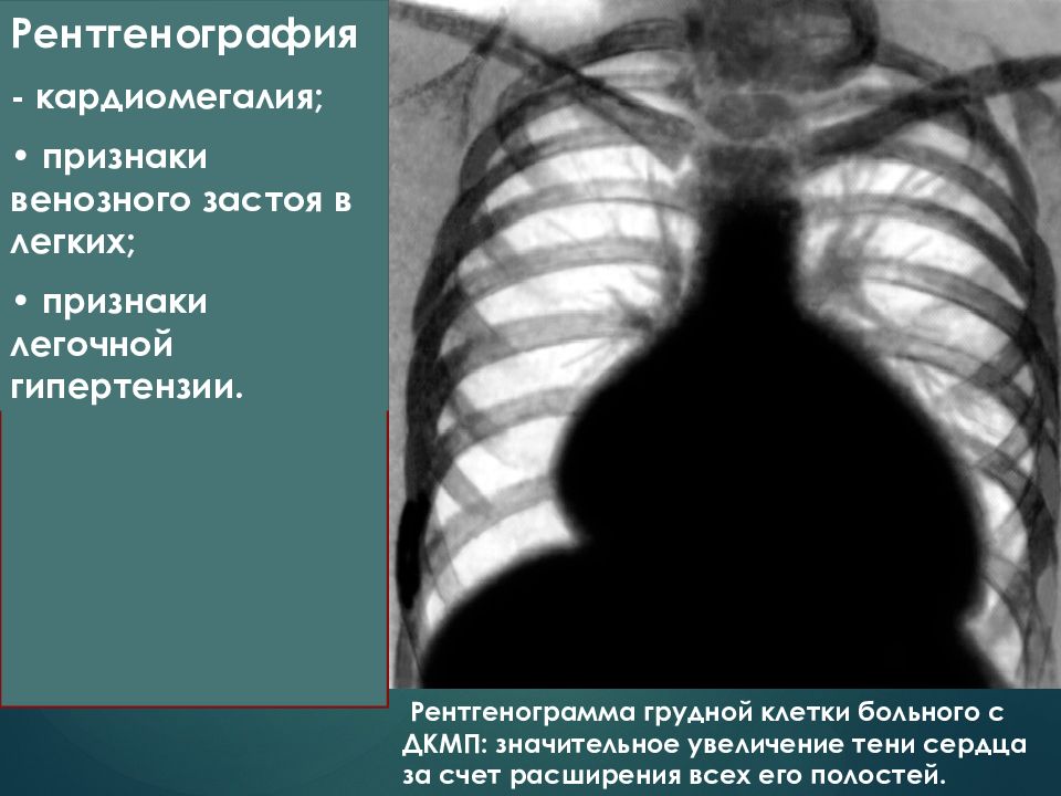 Кардиомегалия. Кардиомегалия рентген признаки. Дилатационная кардиомегалия рентген. Рентгенография органов грудной клетки при ДКМП.