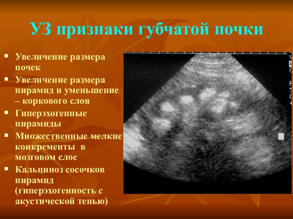 Уз признаки. Губчатая почка УЗИ картина. Синдром гиперэхогенных пирамид почек УЗИ. Гиперэхогенные пирамидки в почках на УЗИ.