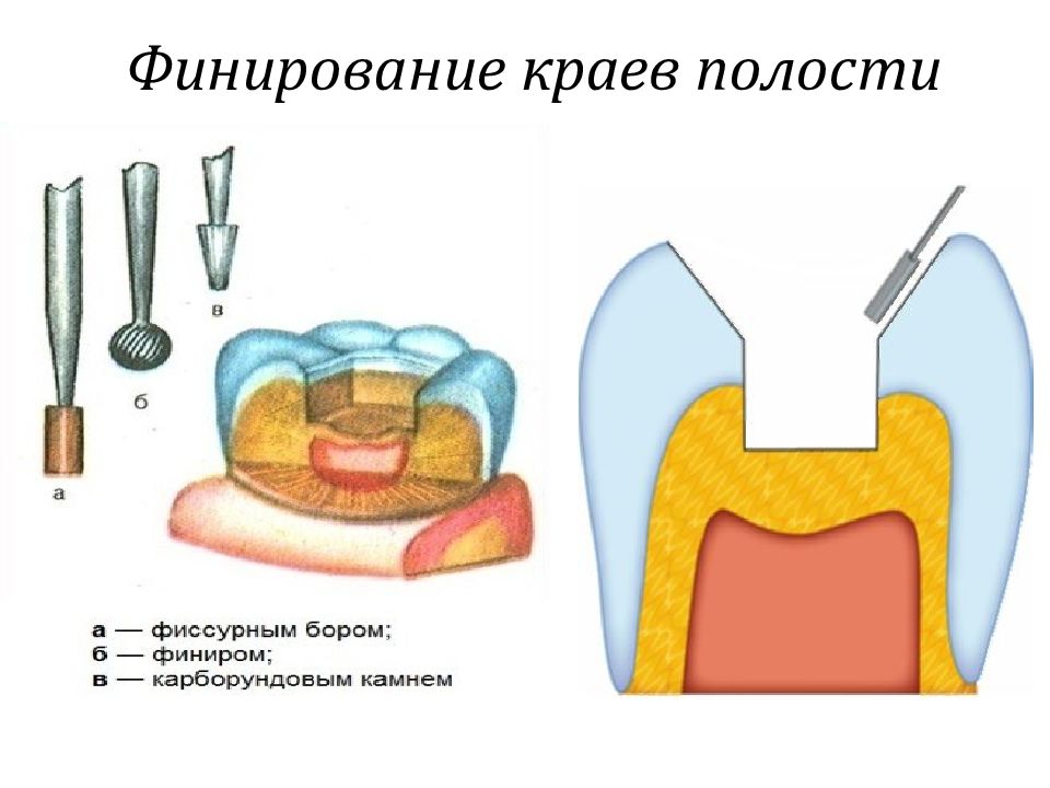 Препарирование кариозных полостей по блэку презентация