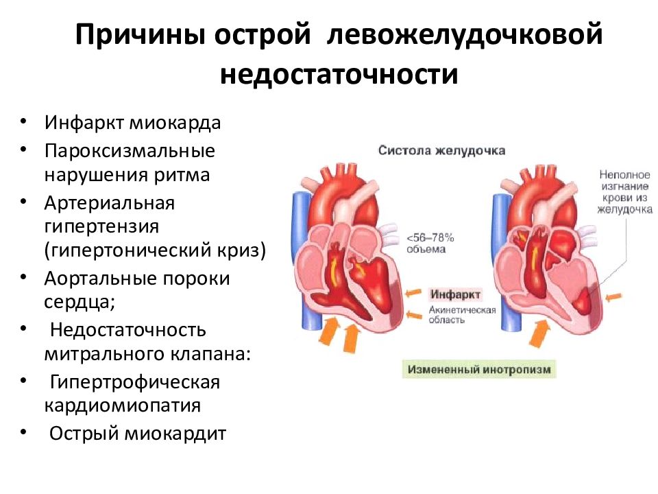 Левожелудочковая недостаточность презентация