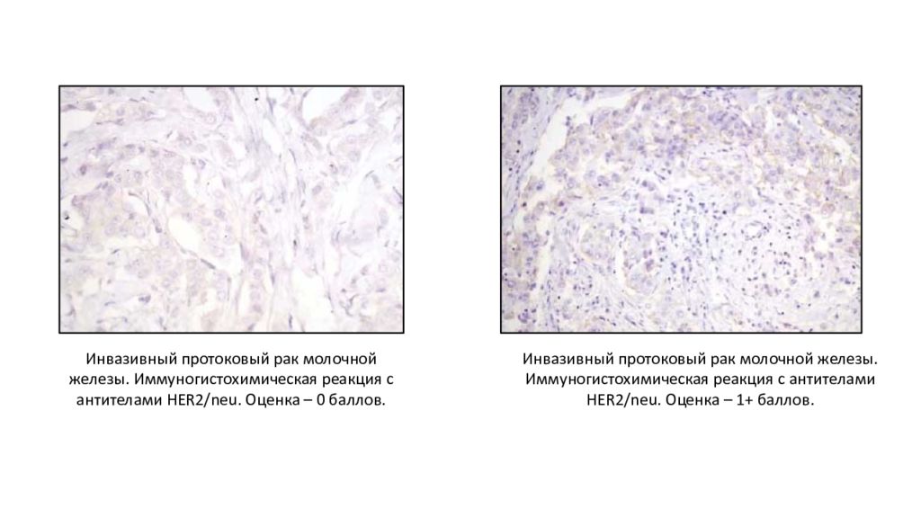 Инвазивные молочные железы. Her2 neu гистология. ИГХ окрашивание. Иммуногистохимические методы исследования презентация. Иммуногистохимическая реакция к her2.