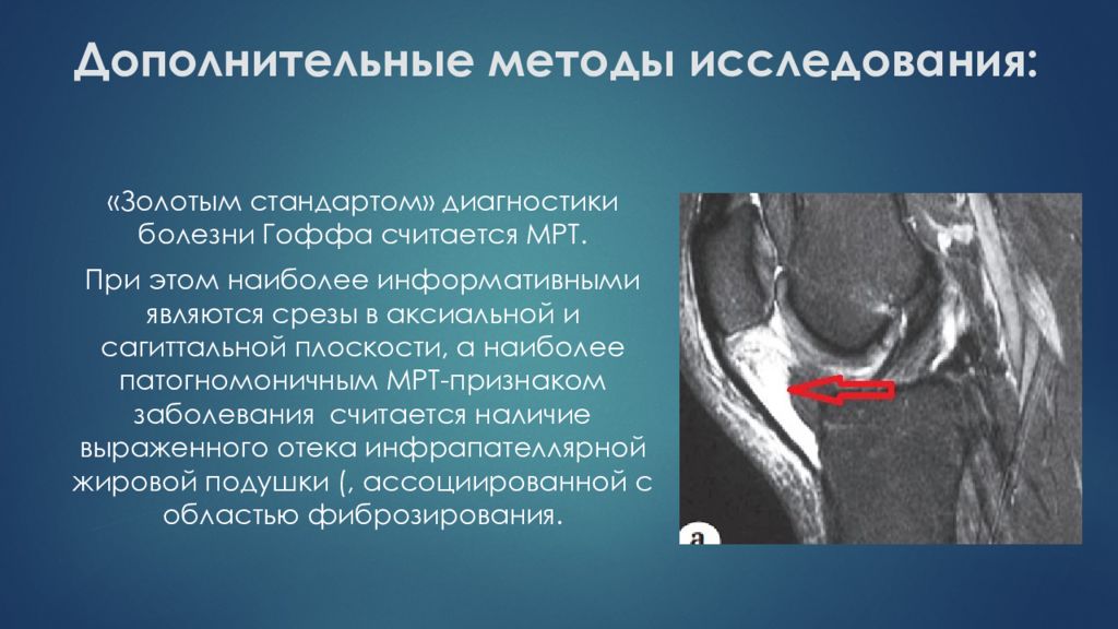 Отек клетчатки. Клетчатка Гоффа коленного сустава. Синдром жирового тела Гоффа.