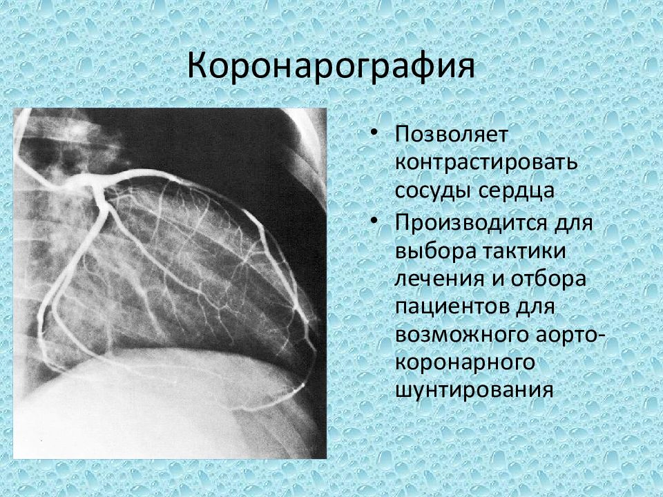 Коронарография сердца через руку. Коронарография сердца. Коронароангиография сердца. Каронографические исследования сердца.