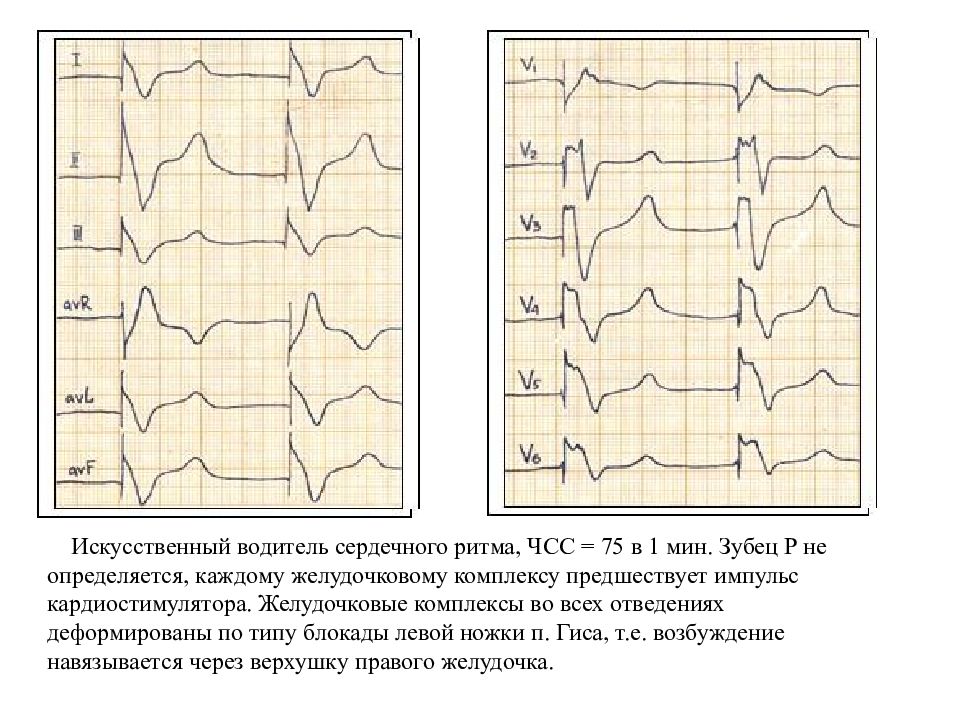 Водитель ритма. Искусственный водитель ритма сердца. ЭКГ при искусственном водителе ритма. ЭКГ при искусственном водителе ритма сердца. Искусственный водитель ритма сердца на ЭКГ.