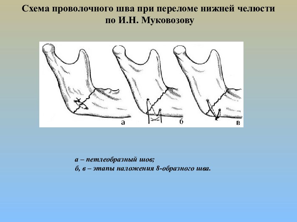 Травмы челюстно лицевой области презентация