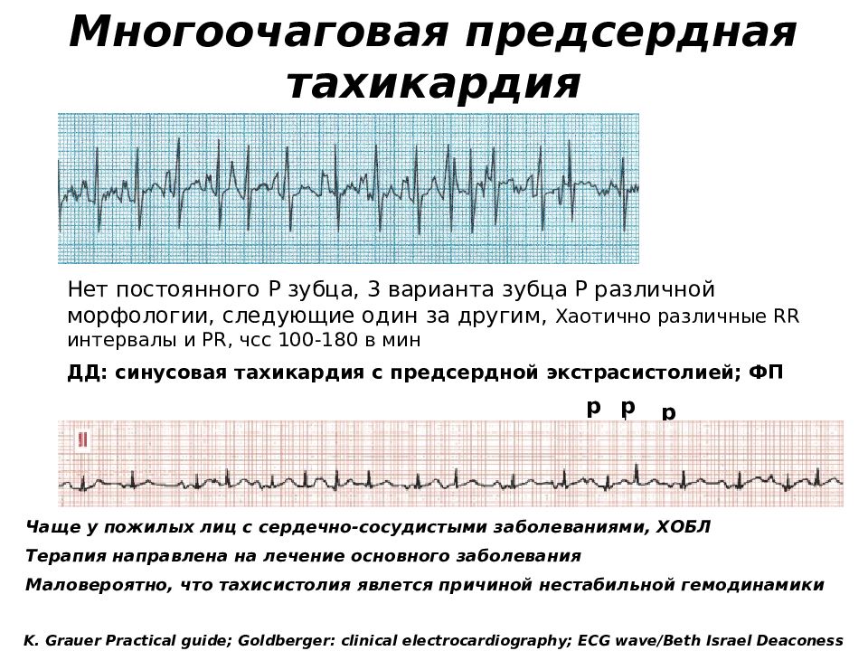 Предсердная тахикардия. Многоочаговая предсердная тахикардия на ЭКГ. Эктопическая предсердная тахикардия. Мультифокальная предсердная тахикардия. Мультифокальная предсердная тахикардия на ЭКГ.