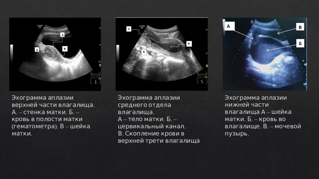 Полость расширена. Врожденная. Аплазия матки. Аплазия матки и влагалища.