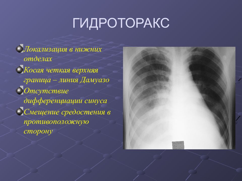 Гидроторакс легких. Правосторонний малый гидроторакс. Правосторонний гидроторакс рентген. Гидроторакс и гидроперикард. Гидроторакс клинические проявления.