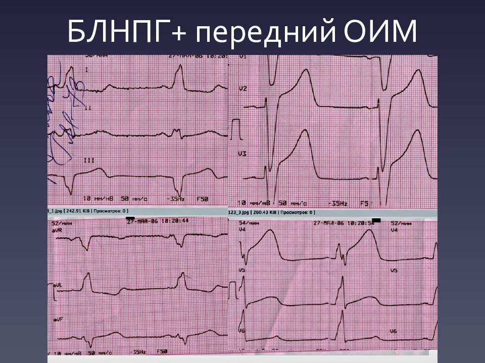 Элевация сегмента st что это