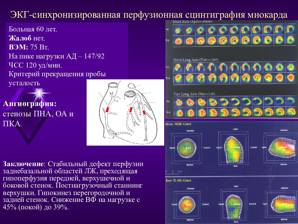 Сцинтиграфия миокарда. ЭКГ синхронизированная сцинтиграфия миокарда. Перфузионная ОФЭКТ миокарда. Однофотонная эмиссионная компьютерная томография миокарда. ОФЭКТ кт миокарда.