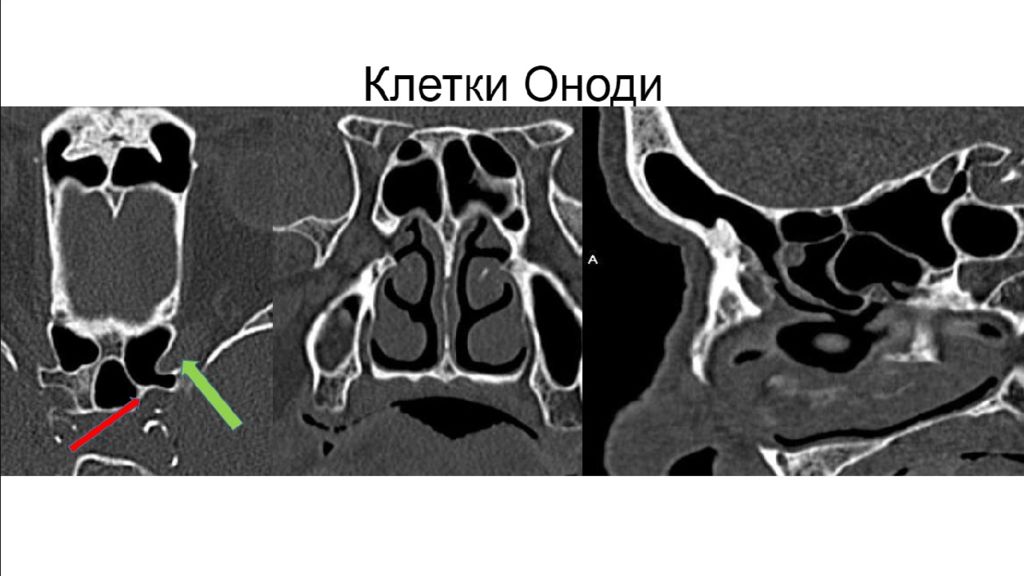 Кт клетки. Ячейки Оноди на кт. Клетка Галлера решетчатого Лабиринта кт. Ячейка Оноди решетчатого Лабиринта кт. Клетки решетчатого Лабиринта Оноди.