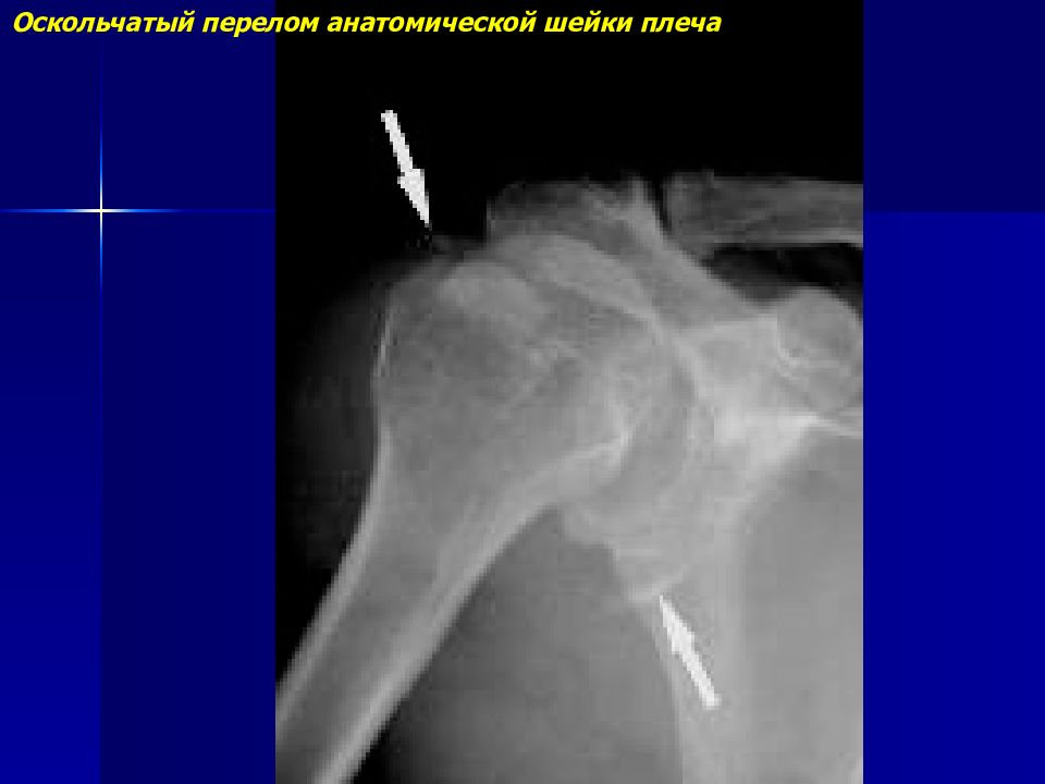 Оскольчатый перелом. Перелом хирургической шейки плеча рентген. Аддукционный перелом шейки плеча рентген. Оскольчатый перелом головки плечевой кости рентген. Абдукционный перелом шейки плечевой кости рентген.