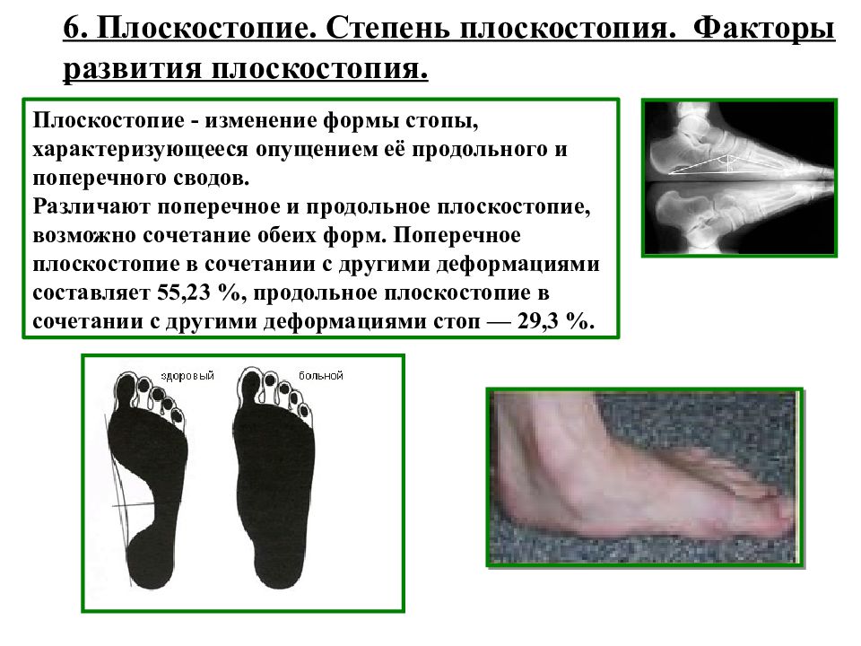 Плоскостопие виды и степени в картинках