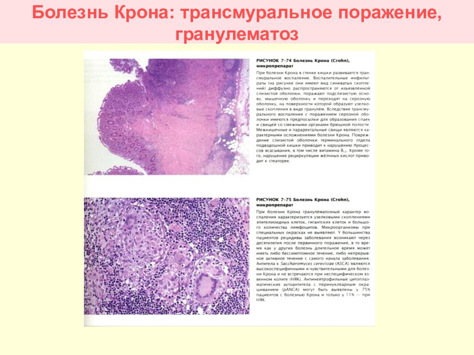 Болезнь крона гистологическая картина