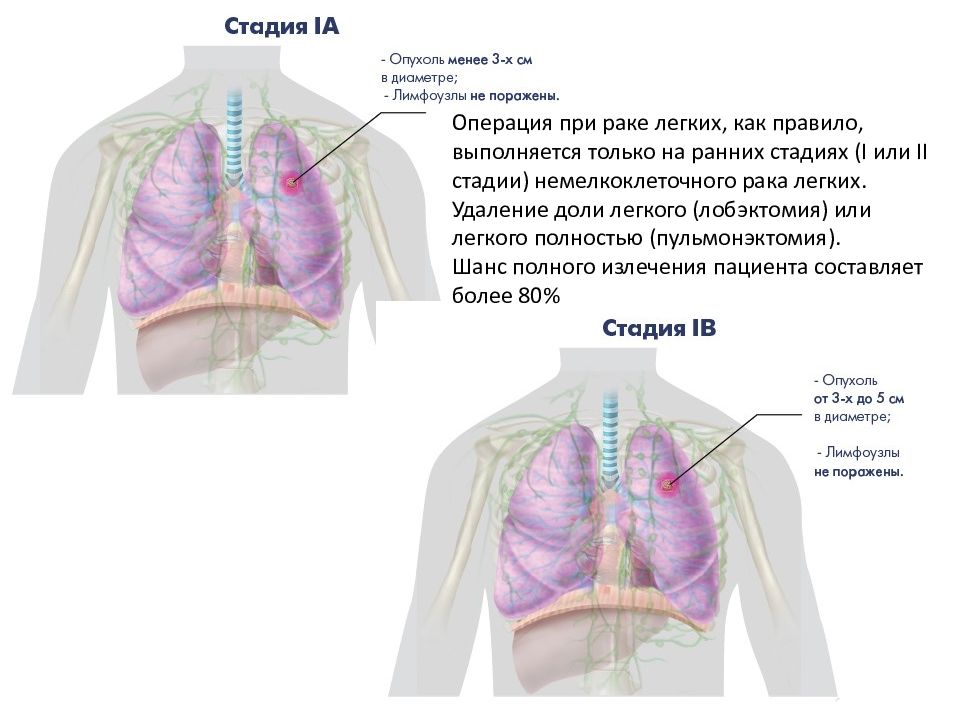 Стадии рака легкого картинки