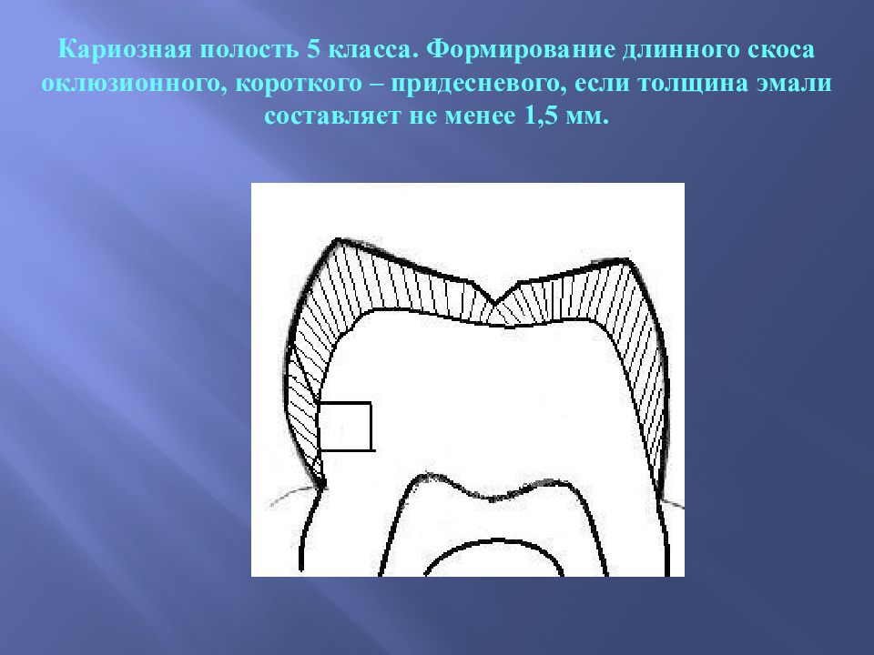 Края кариозной полости. Формирование кариозных полостей 5 класса. Формирование кариозной полост. Сформированная кариозная полость 5 класса. Формирование краев кариозной полости.