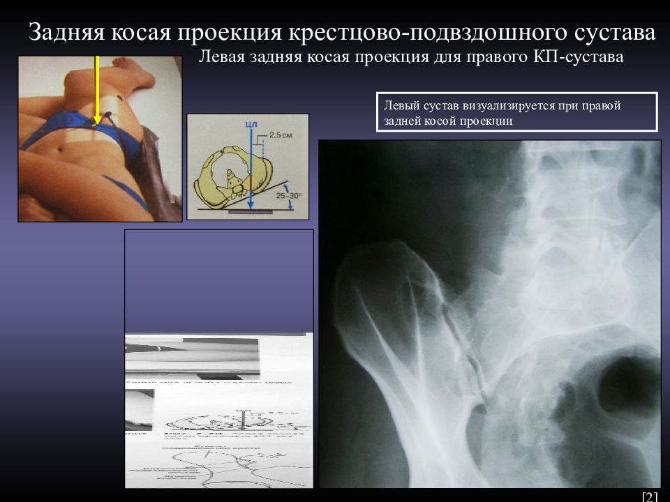 Косая проекция. Рентгенография крестцово-подвздошного сочленения укладка. Косая проекция крестцово-подвздошное сочленение. Рентген крестцово-подвздошных сочленений укладка. Укладка на крестцово-подвздошные сочленения.