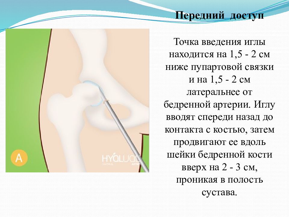 Пункция коленного сустава. Пункция бедренного сустава. Пункция тазобедренного сустава техника выполнения. Иглы для пункции тазобедренного сустава. Пункция тазобедренного коленного.