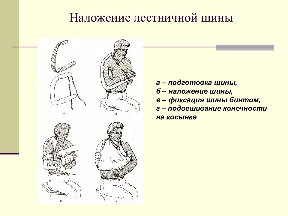 Виды наложения шин. Порядок наложения шины. Алгоритм наложения шины. Общие правила наложения шин.