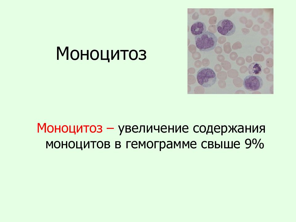 Повышение моноцитов. Моноцитоз. Моноцитоз в крови. Лейкопения и моноцитоз. Увеличение количества моноцитов.