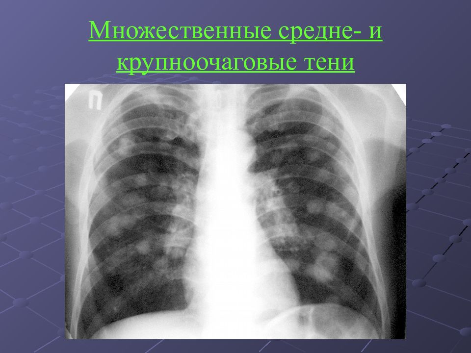 Лучевая диагностика заболеваний легких презентация