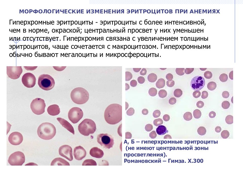 Ткань эритроцитов. Изменение морфологии эритроцитов при анемиях. В12 анемия эритроциты гиперхромная. Гипохромия и гиперхромия. Морфология эритроцитов при различных анемиях.