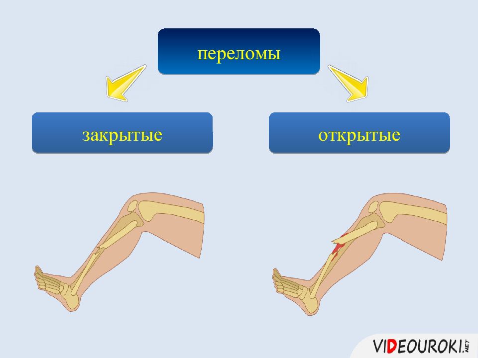 Рассмотрите рисунок с изображением травмы опорно двигательной системы назовите вид